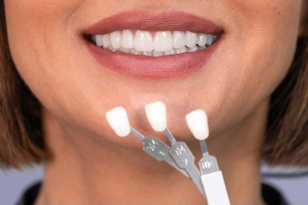 veneers Christchurch